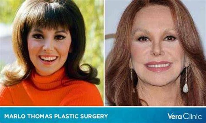 Exploring Marlo Thomas and Her Journey Through Plastic Surgery